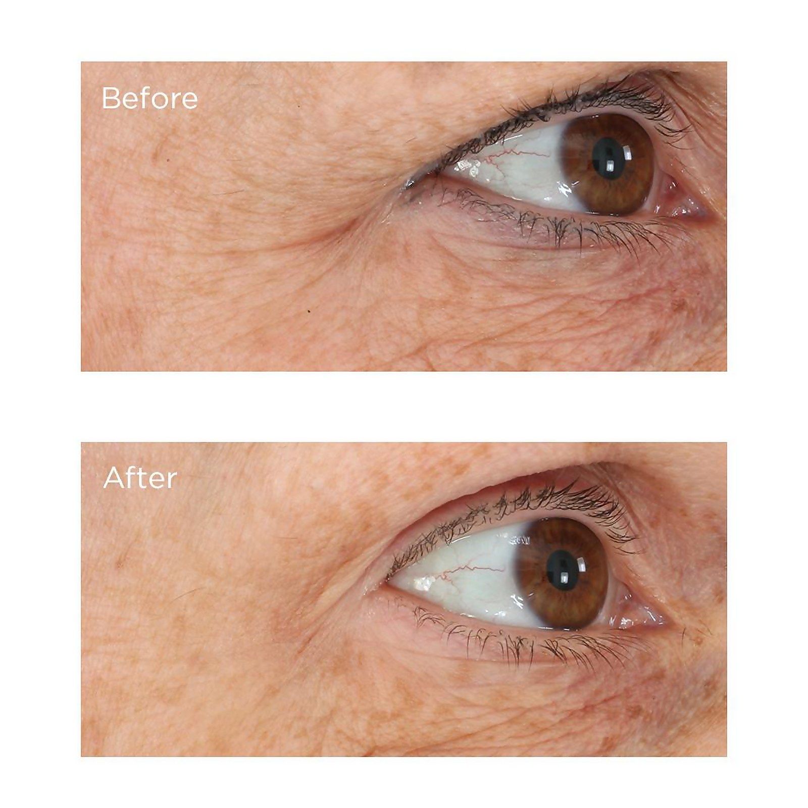 resultados antes y después de su producto para el contorno de ojos Perricone MD opiniones